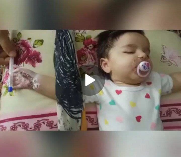 سوختگی دست نوزاد ۴ ماهه بیمارستان رازی قائمشهر چه بود؟