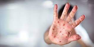 واکسیناسیون ، مهمترین راه پیشگیری از طغیان سرخک