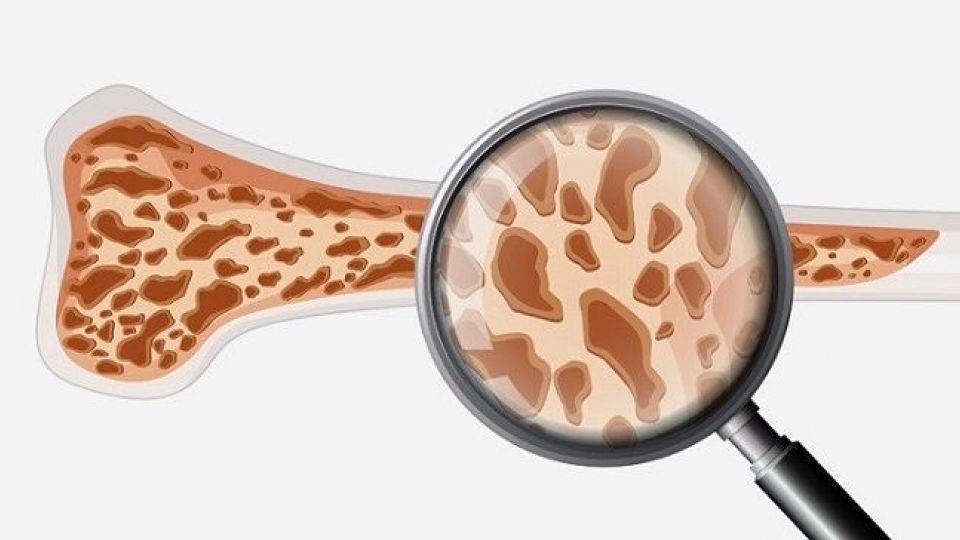 راهکارهای گریز از پوکی استخوان، بیماری قرن