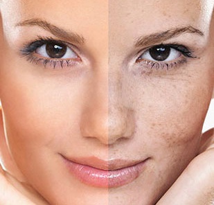 با راهکارهای خانگی از شر لک های صورتتان خلاص شوید