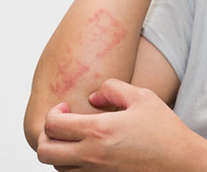 کنترل اگزمای بدن با چند روش ساده