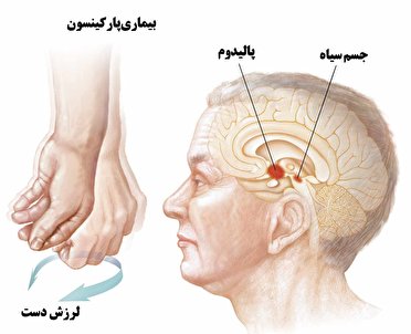 ماه آوریل، ماه آگاهی از بیماری پارکینسون گزارش