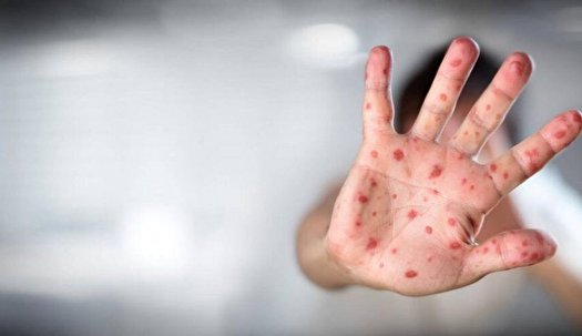افزایش تعداد کشور‌های اروپایی با موارد ابتلا به آبله میمون