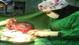 خارج کردن توده ۵ کیلوگرمی از شکم مادر باردار؛ جنین سالم است