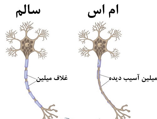 استان مرکزی، پیشرو در درمان و تشخیص بیماران ام اس