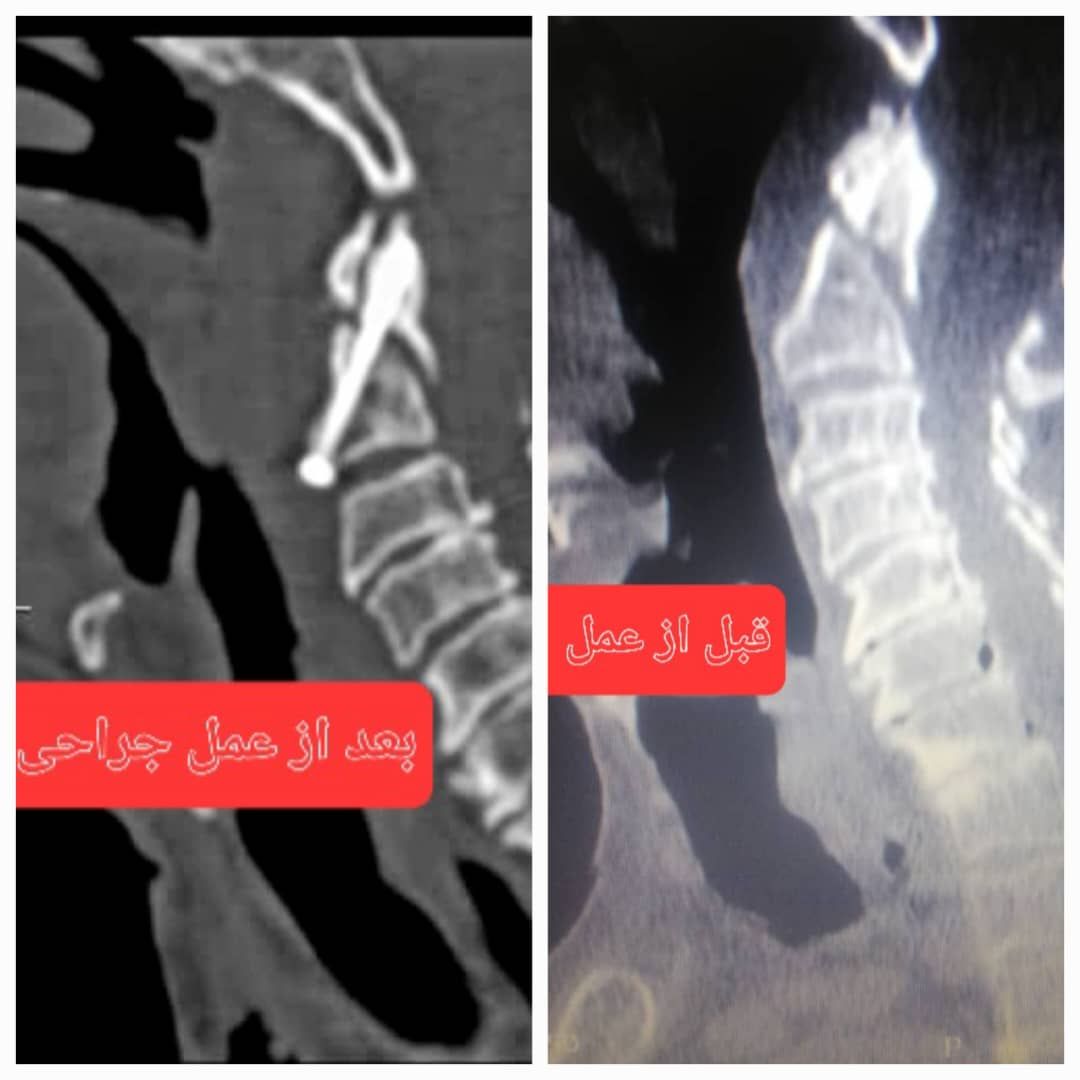 عمل موفقیت‌آمیز جراحی نخاعی در بیمارستان ولی عصر (عج) بروجن