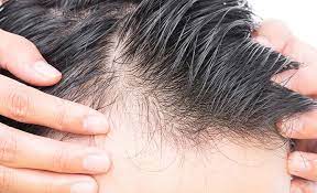 آیا چاقی باعث ریزش موها میشود؟