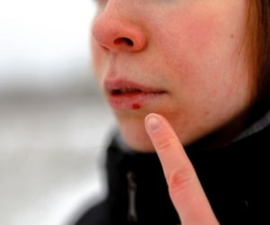 درمان سریع تبخال لب با آنچه در خانه دارید