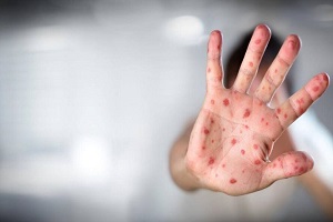 آبله میمون چیست و چه علائمی دارد؟